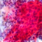 Sunderland cancer diagnosis pioneers scoop £750,000 investment
